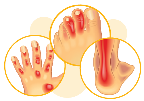 Illustrations of a hand, ankle, and foot, showing areas that can be affected by psoriatic arthritis.