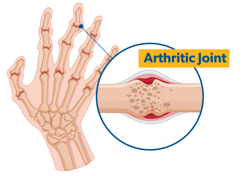 graphic of a hand with an arthritic joint