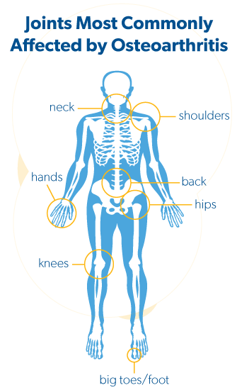 Skelton showing joints affected by osteoarthritis