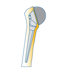 A partial shoulder joint replacement, with a ball implant.