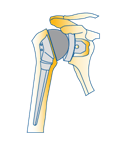 An anatomic total shoulder joint replacement, with a ball and socket implant.