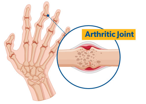 Rheumatoid Arthritis
