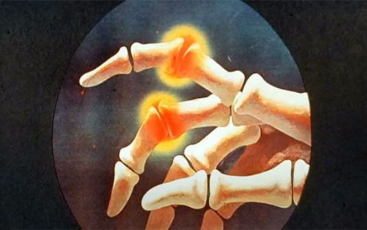 Rheumatoid-Arthritis