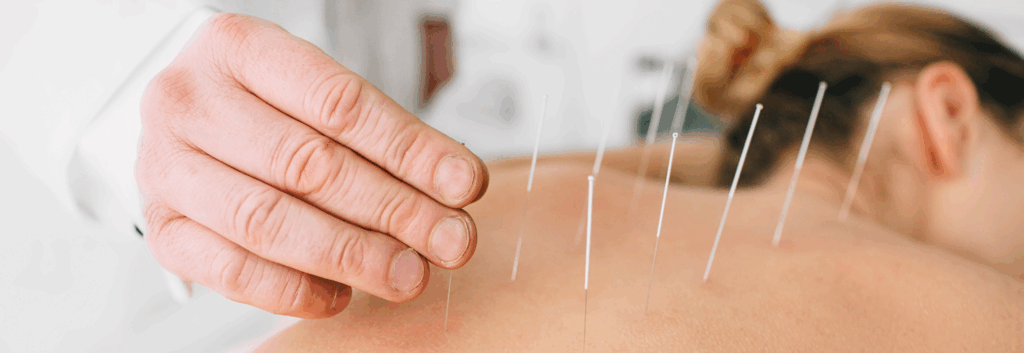 women doing acupuncture